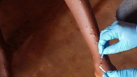 Mpox : l’OMS approuve le premier test de diagnostic pour une utilisation en situation d’urgence
