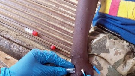 Mpox en Afrique : les enfants particulièrement menacés par la nouvelle variante
